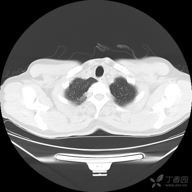 回肠末端肠壁增厚并腹腔淋巴结肿大,大家帮忙分析一下,有病理