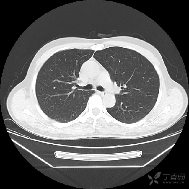 回肠末端肠壁增厚并腹腔淋巴结肿大,大家帮忙分析一下,有病理