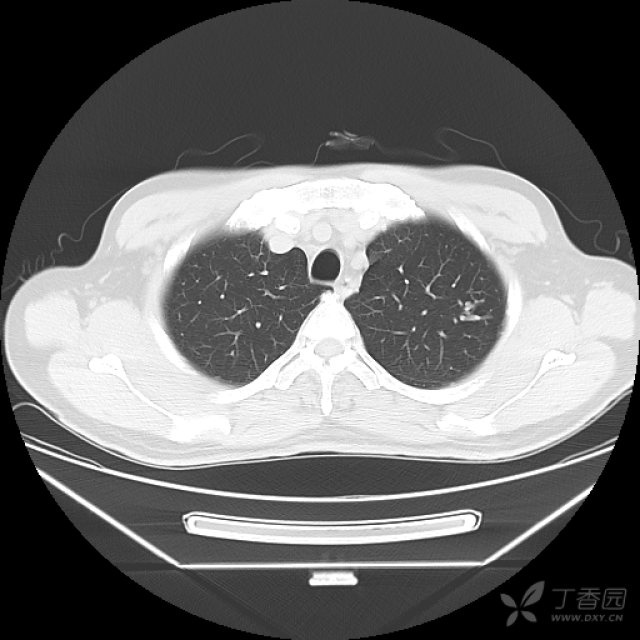 回肠末端肠壁增厚并腹腔淋巴结肿大,大家帮忙分析一下,有病理