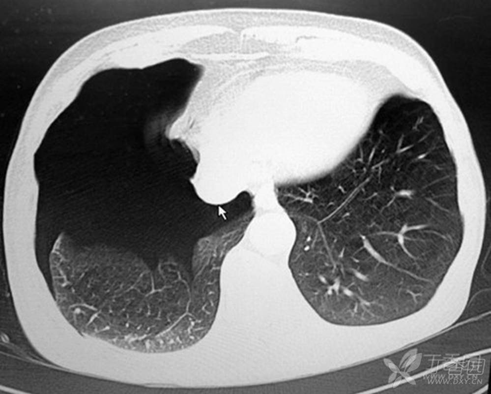 影像读片:是右侧气胸,还是巨大肺大泡?