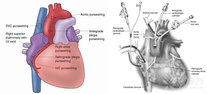 心脏手术学习系列:体外循环的插管