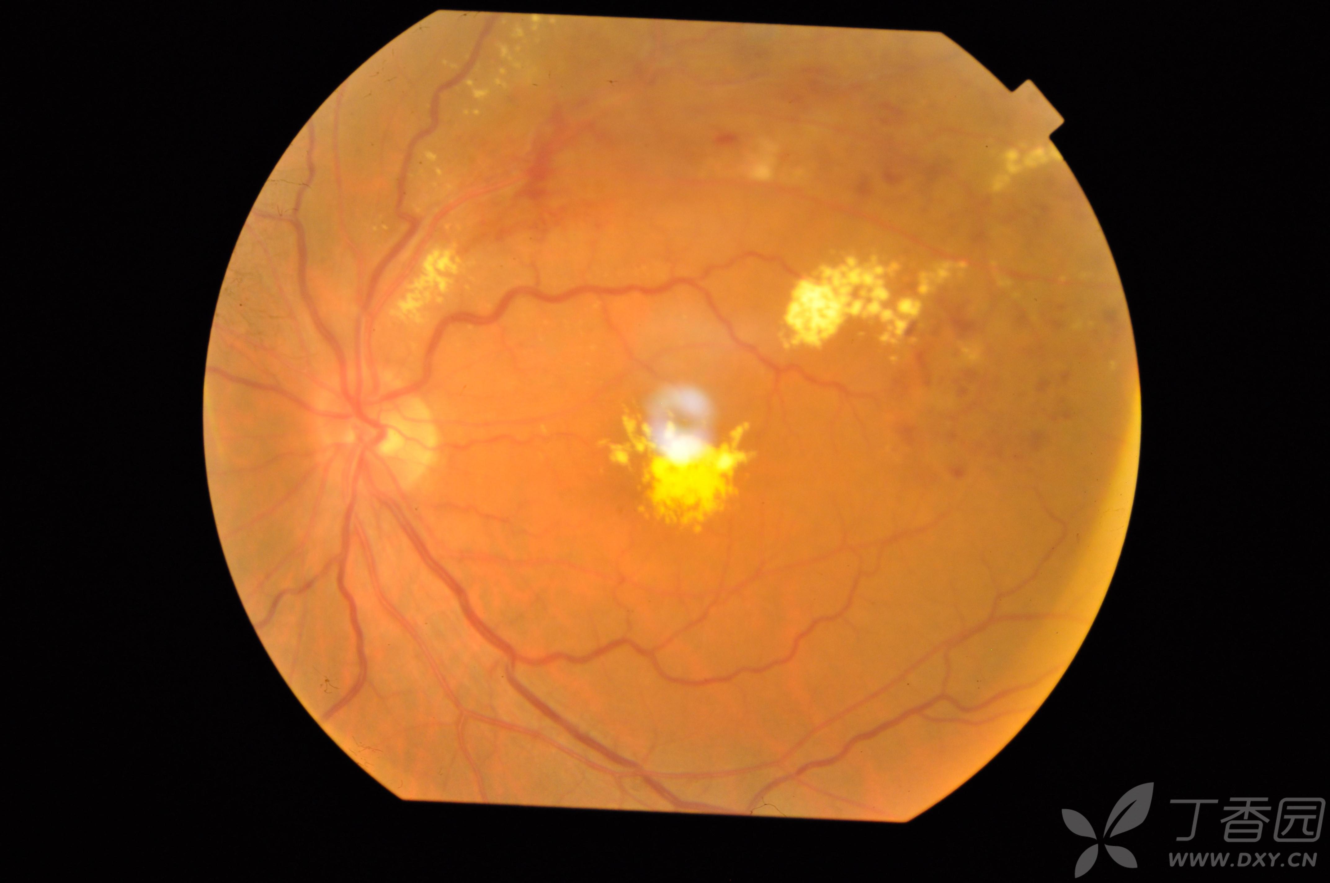 成人coats病? - 眼科专业讨论版 -丁香园论坛