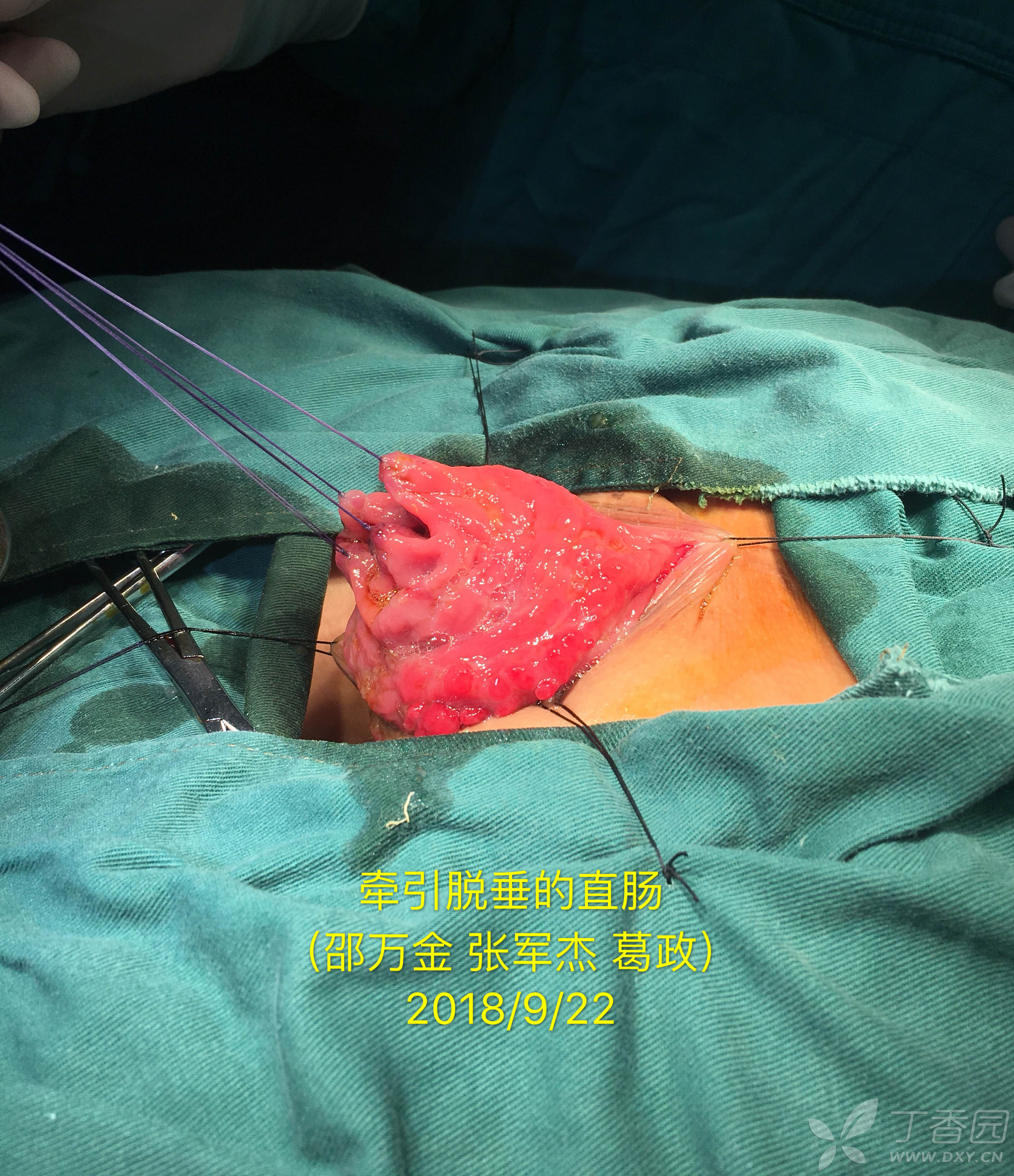 直肠脱垂delorme手术演示病例分享(邵万金)
