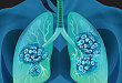 欧盟批准阿斯利康 Imfinzi 用于局部晚期不可切除 NSCLC