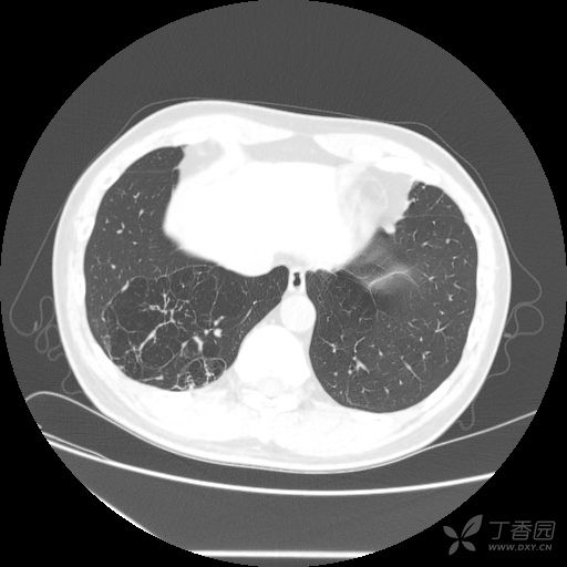全国有多少人有肺部结节 3302674619815062198-8w.jpg