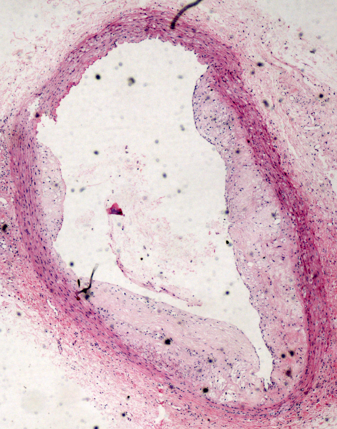 请问下各位,如何用image j测as后动脉管腔面积呢?