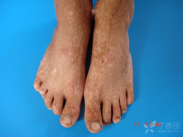 水源性肢端角化在?一个外科医生遇到的皮肤问题,求助各位朋友.