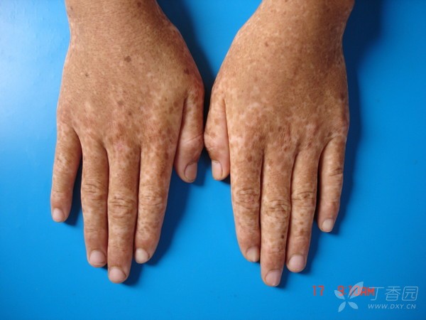 水源性肢端角化在?一个外科医生遇到的皮肤问题,求助各位朋友.