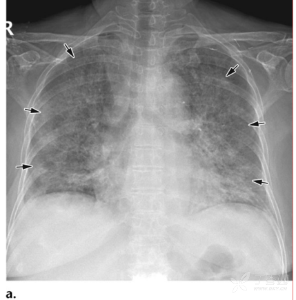 病毒性肺炎影像表现 - 影像医学和核医学讨论版 -丁香园论坛