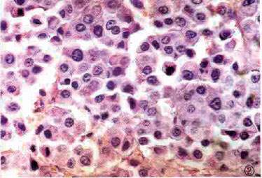 MDA-MB-231;乳腺导管癌细胞