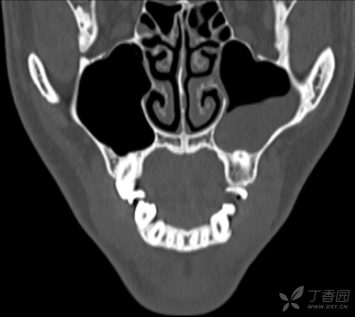 "牙源性"上颌窦囊肿一例,比较少见,求征集手术方案