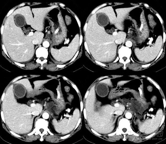 腹部彩超:肝内高回声结节,肝囊肿,胆囊壁毛厚,胆囊擘胆固醇结晶,胆囊