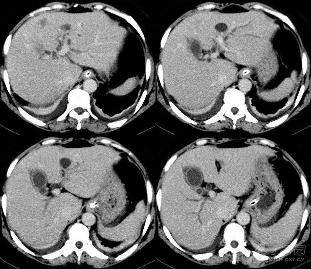辅助检查:胰腺系列:lps:16.2u/l,amy 34.0u/l,尿淀粉酶:199.0u/l.