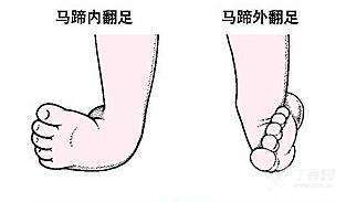 "马蹄足"名字的由来