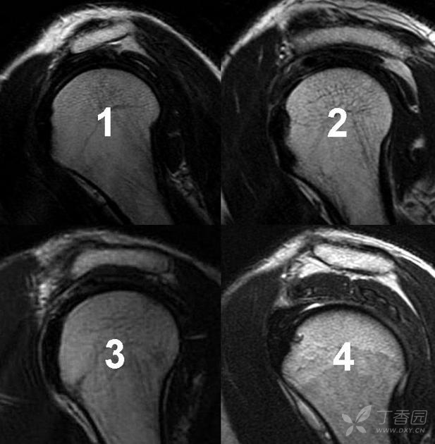 疼痛诊疗 a-h间距测量值为x线图像中测得的肱骨头顶与肩峰端前外下角