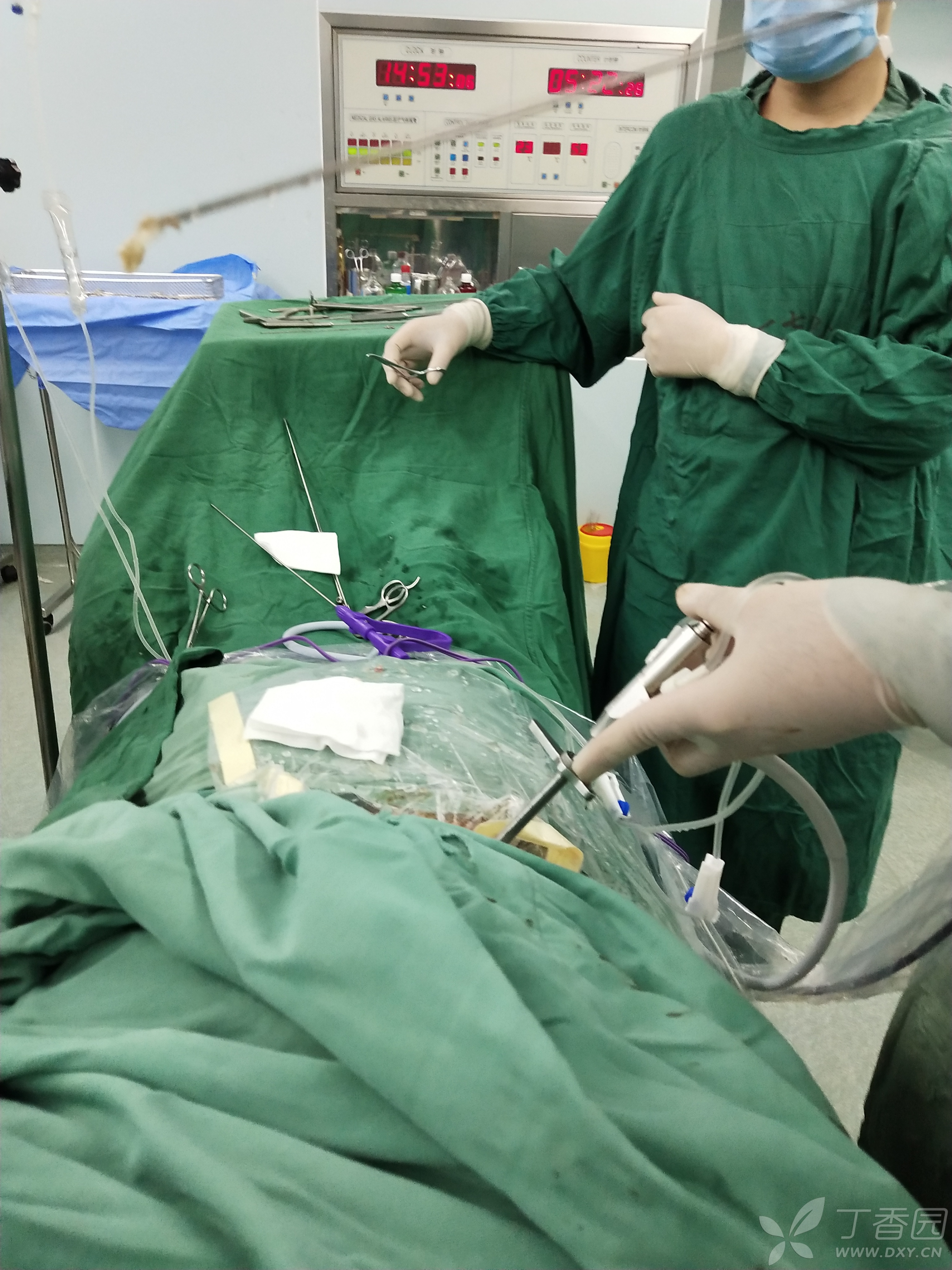 黄骨头脊柱内镜手术日记——腰1-2椎间盘脱出(i~ii层,1~2区,左,b域)