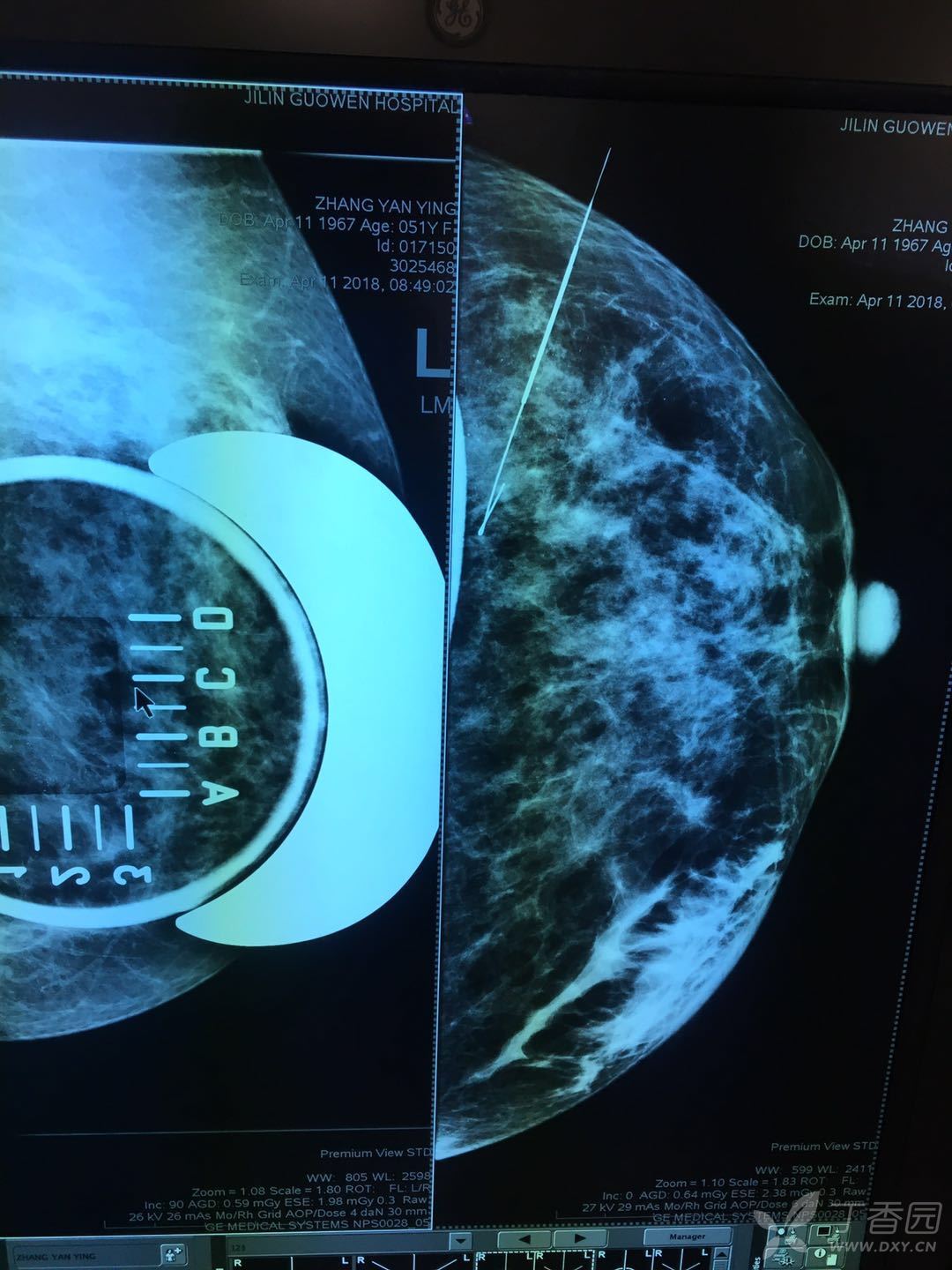 无创诊断三阴性乳腺癌与复旦分型 - 好医术早读文章 - 好医术-赋能医生守护生命