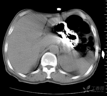 平片,ct伪影与假象 [精华]