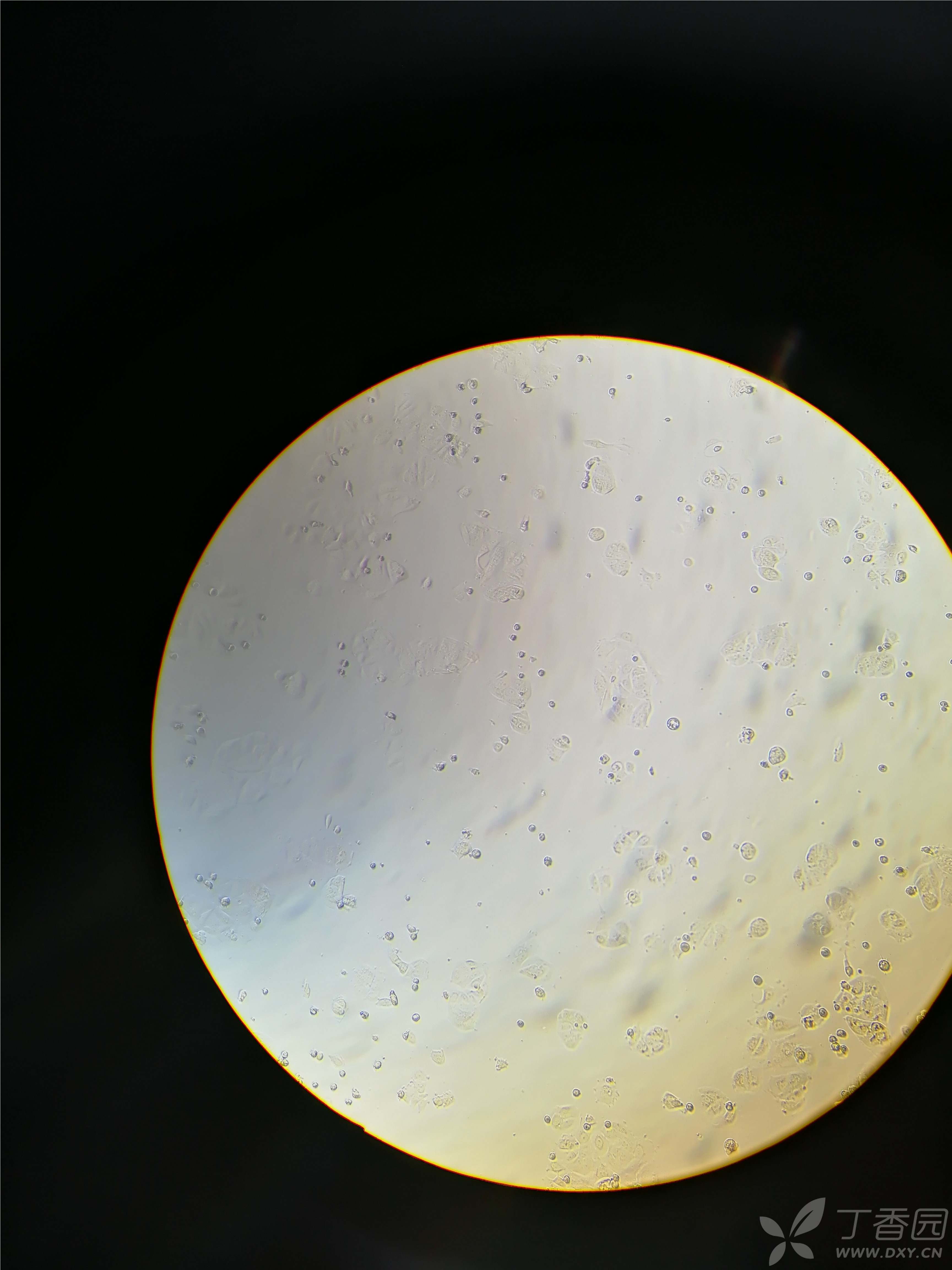 我的mcf-7人乳腺癌细胞形态正常不? - 丁香园论坛