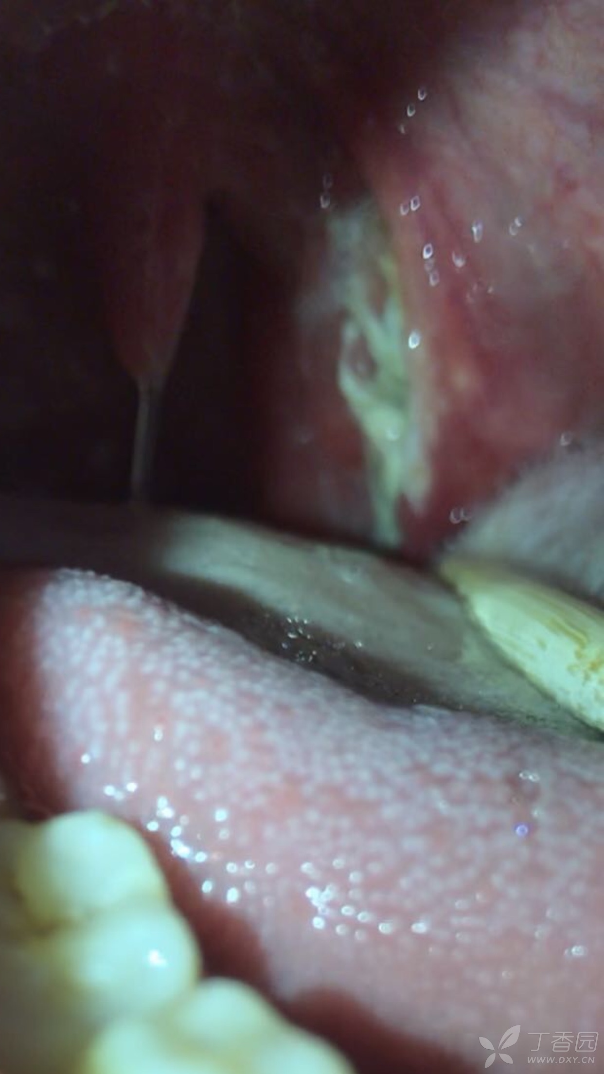 咽部化脓图片图片