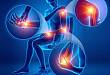 2018 EULAR 关于炎性关节病和骨关节炎疼痛管理的最新指南推荐