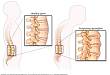 2018 ACR 中轴型脊柱关节炎（axSpA）治疗指南更新