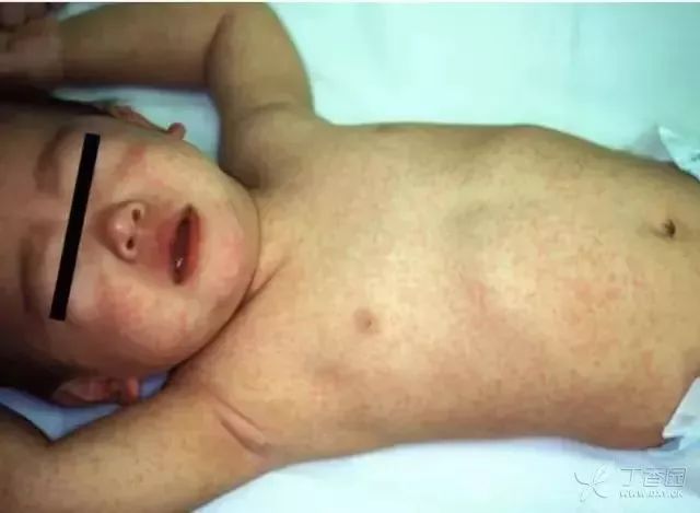 实用 10 种儿童皮疹疾病鉴别要点