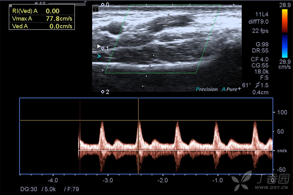 再用血管探头采集双侧桡动脉血流频谱.