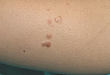 表现为疼痛性丘疹的恶性肿瘤，你见过吗？