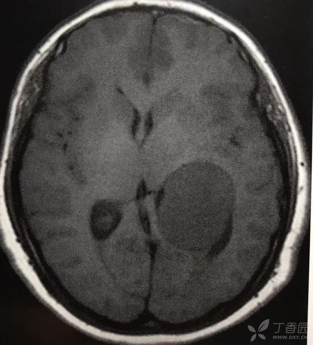 mri征象:1,典型的脑膜瘤多变现未等或稍短t1,等或稍长t2信号类圆形