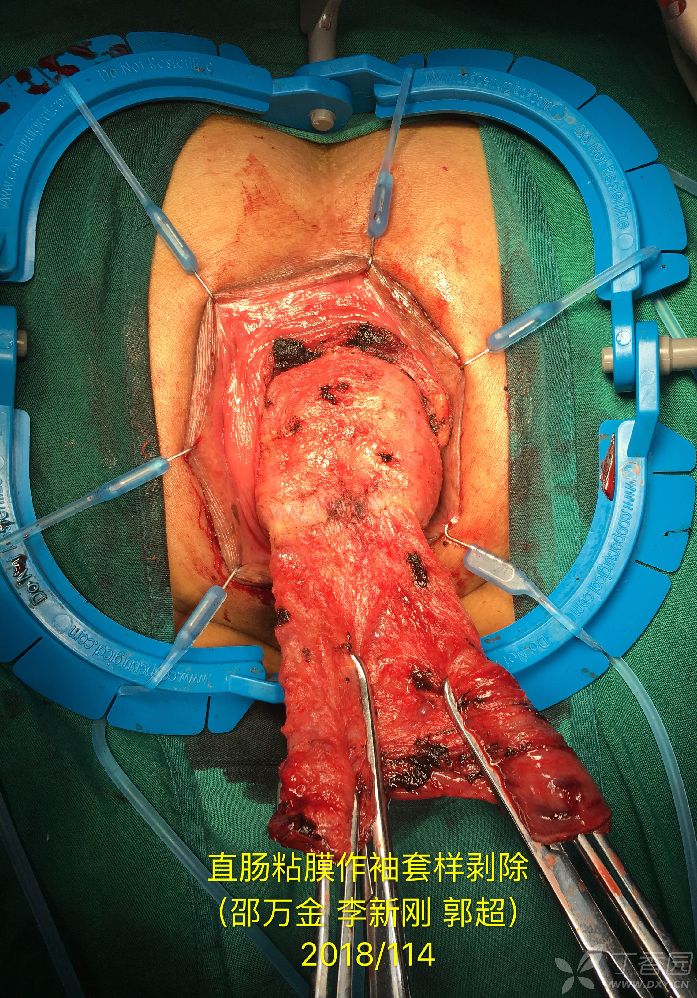 邵万金直肠脱垂delorme手术