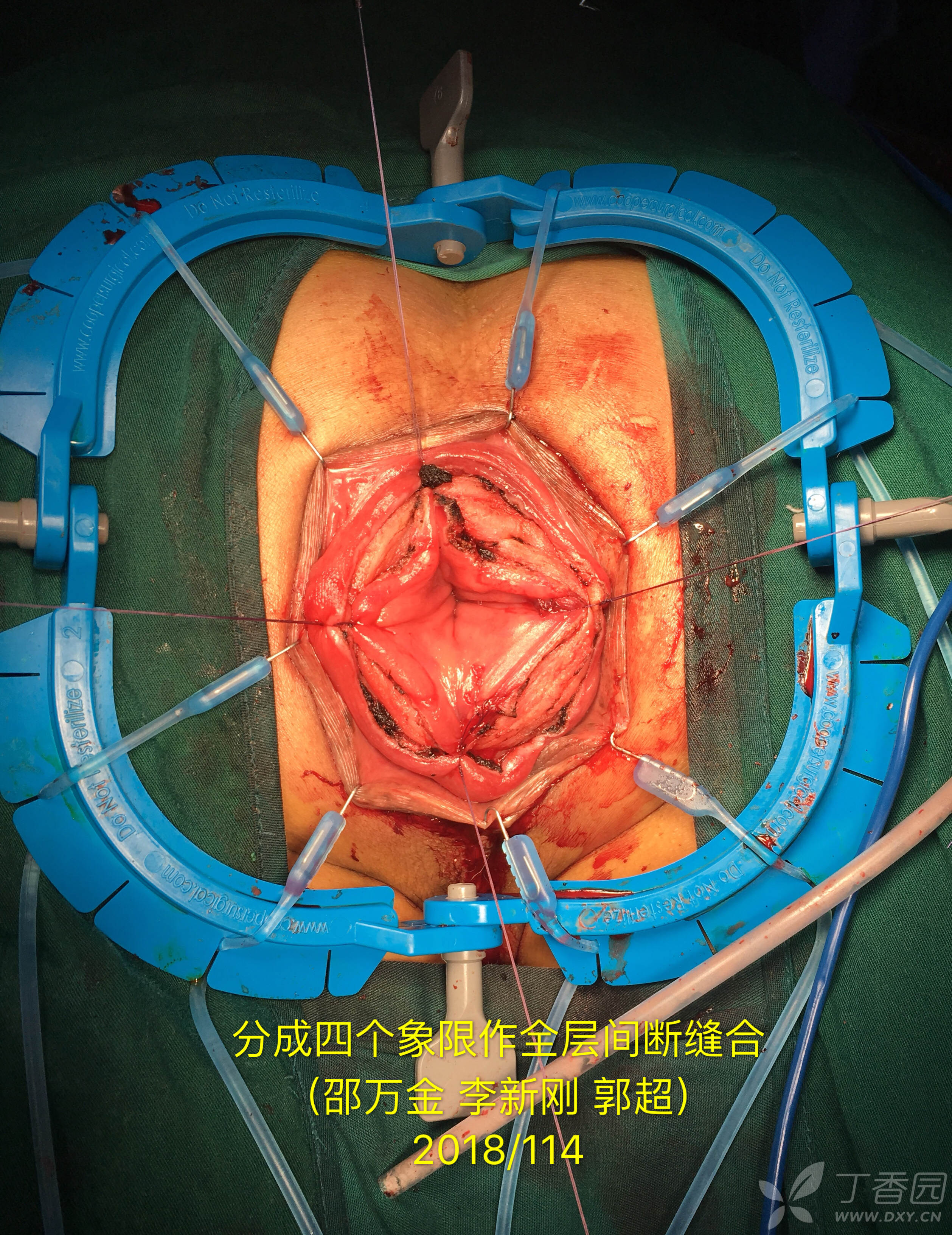 邵万金直肠脱垂delorme手术