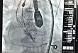 蚌埠医学院第一附属医院再次完成一例挑战性 TAVR 手术，引领安徽省心血管内科技术新高度