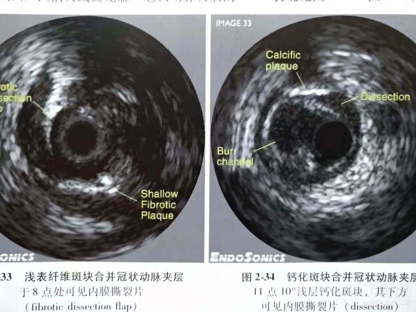 冠脉介入之冠脉夹层 - 丁香园论坛