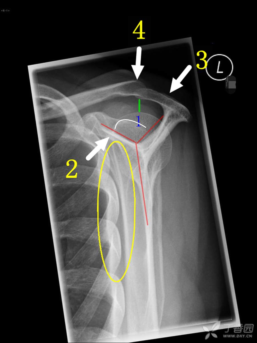 肩峰撞击综合征临床及影像诊断之二 - 丁香园论坛