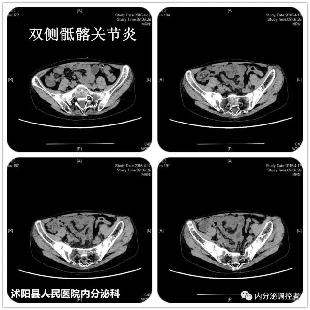 病例剖析 从年轻女性原发性闭经 矮小症伴脊柱关节炎细说 先天性卵巢发育不全症