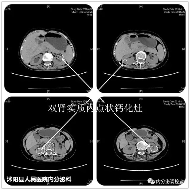 病例剖析 从年轻女性原发性闭经 矮小症伴脊柱关节炎细说 先天性卵巢发育不全症