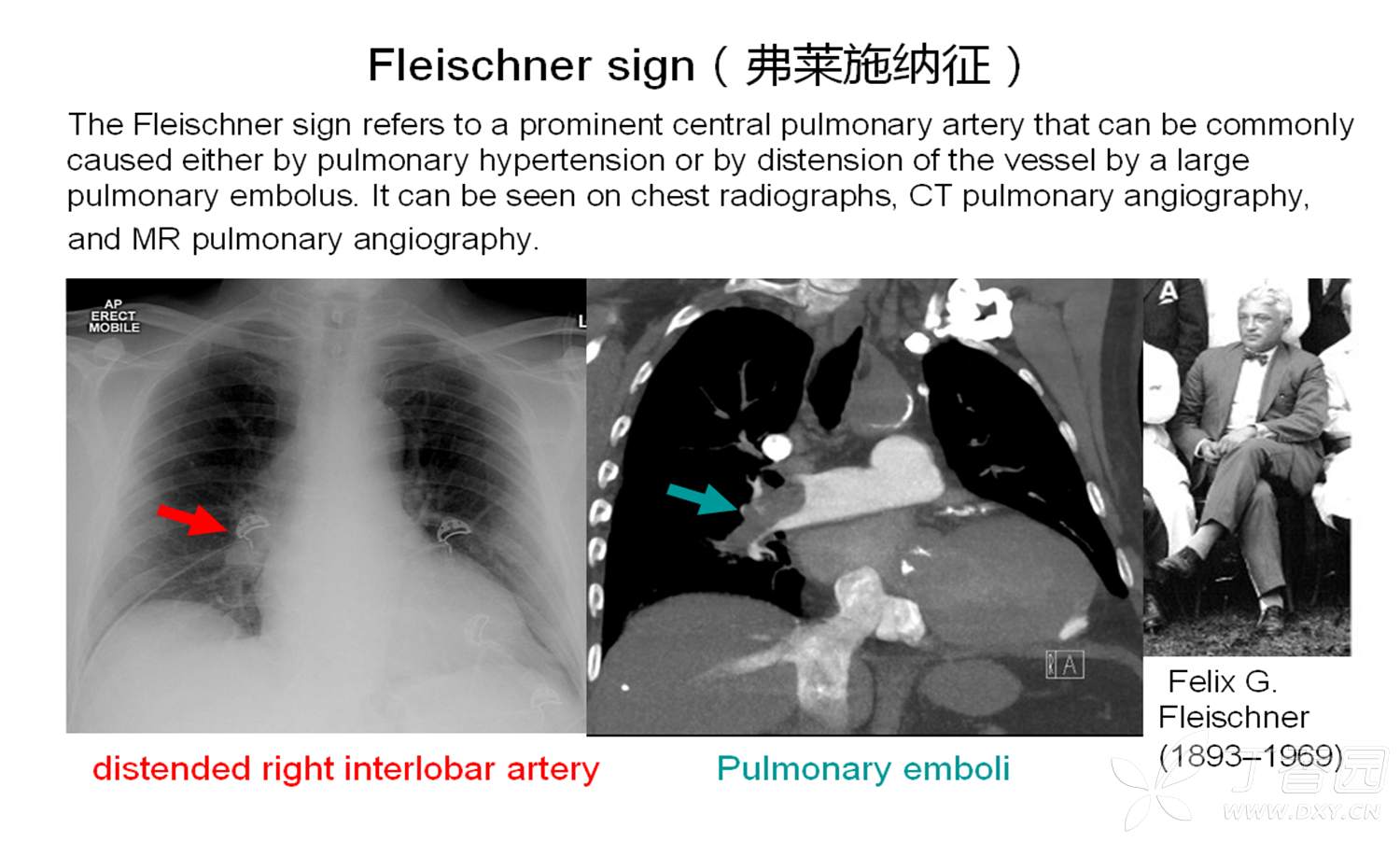 Fleischner sign（弗莱施纳征） - 丁香园论坛