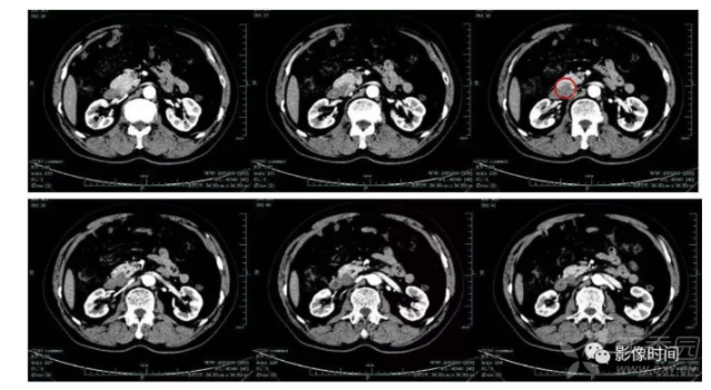 什么是黑色素瘤恶性的 3311652312644380548-8w.png!w640