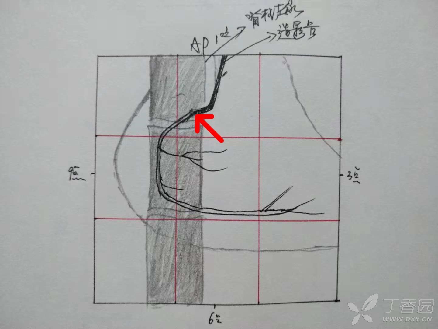 rca左前斜45°,屏幕应该同时显示脊柱右缘,右心缘,膈肌上缘,造影头端