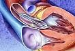 TAVR 术中能省去 BAV 这一步骤吗？