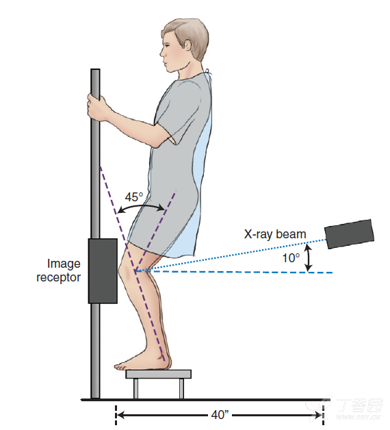 请教大家:膝关节rosenberg位 - 影像核医学 -丁香园论坛
