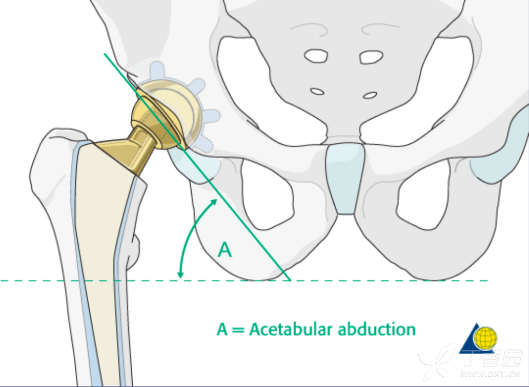 髋臼假体外展角图片