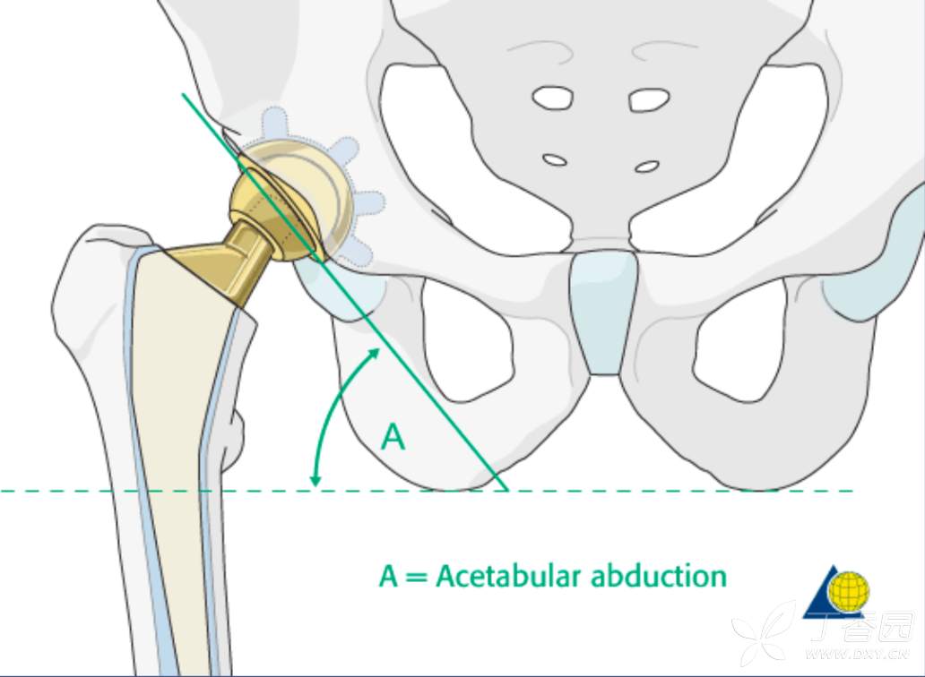 髋臼假体的前倾角和外展角美图2张