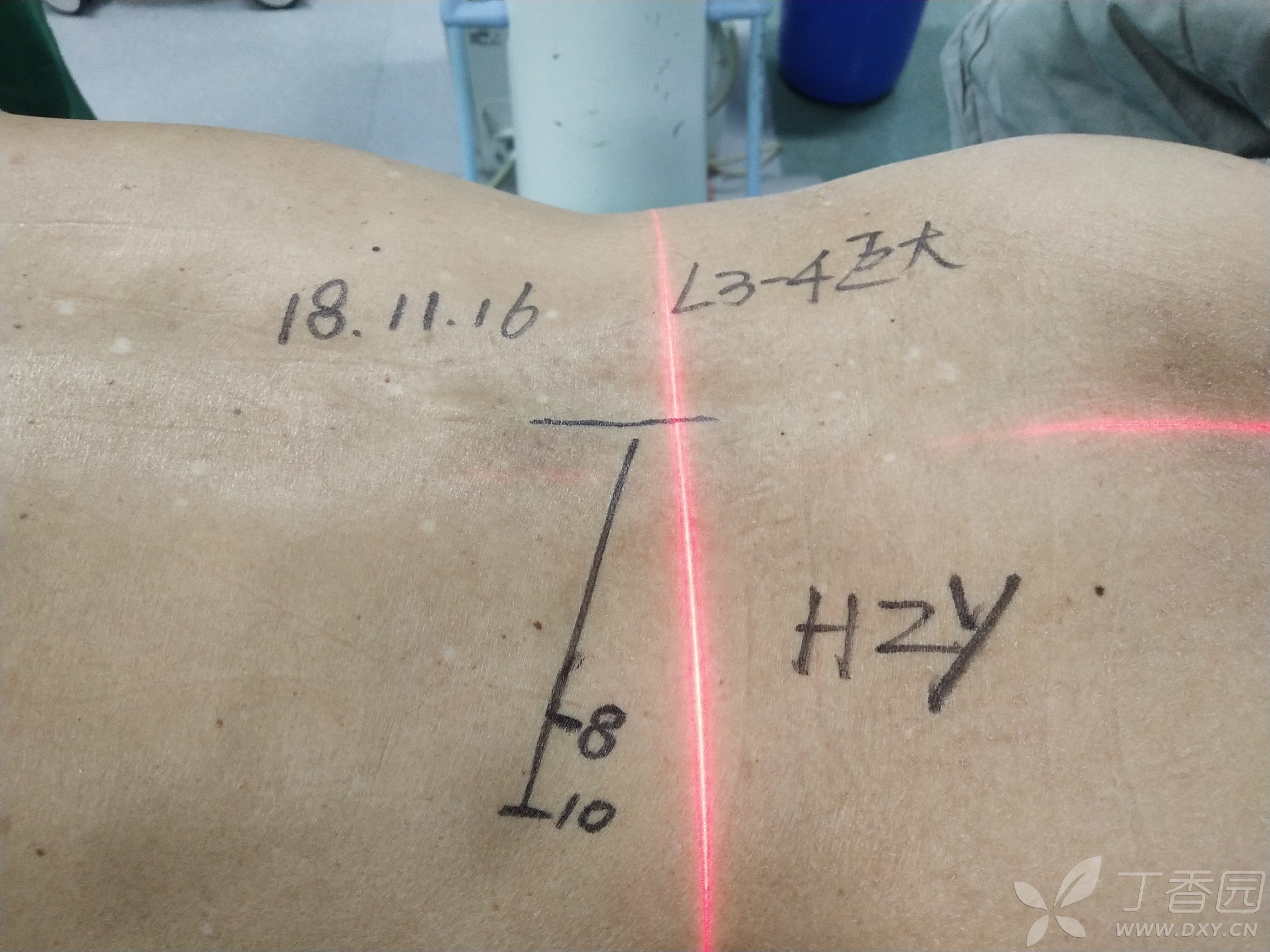 黃骨頭脊柱內鏡手術日記——腰3-4巨大椎間盤突出一例 [病例帖]