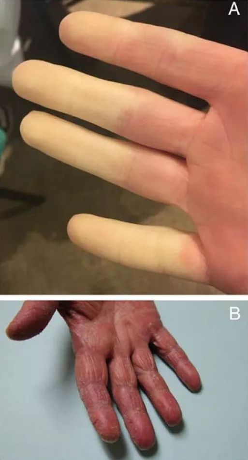 行医笔记:细数皮肌炎自身抗体的临床意义