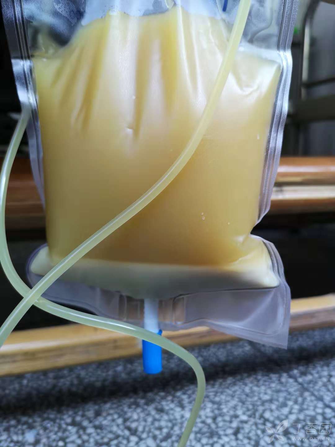 这样过目难忘的胸水你见过吗? - 呼吸与胸部疾病讨论版 -丁香园论坛