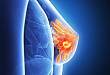 Medscape 精选 |乳腺癌一线治疗的最新进展