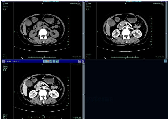 刘爱庆增强CT.jpg