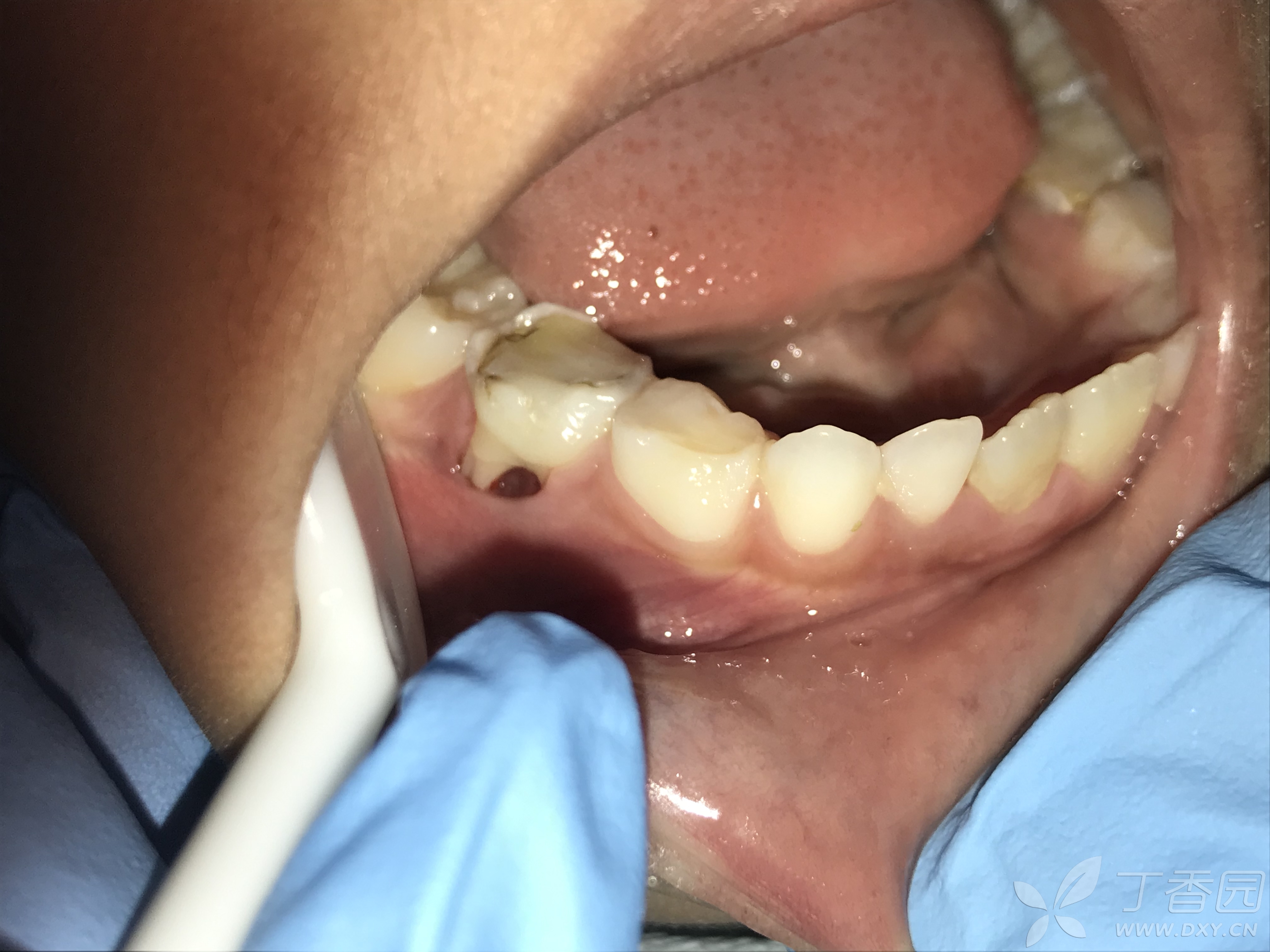 儿童牙根尖炎症状图片图片